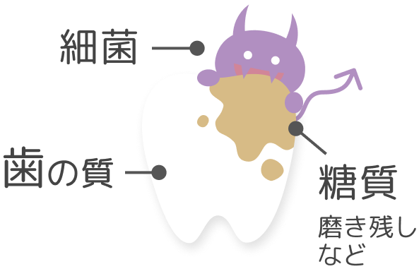 虫歯ができる原因は？